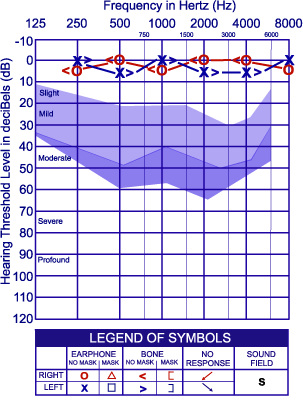 Diagram of normal to moderate loss